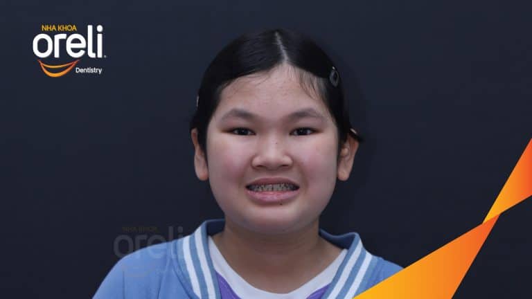 Ca niềng chỉnh cắn ngược trẻ em kết quả đúng khớp sau 12 tháng ở Oreli