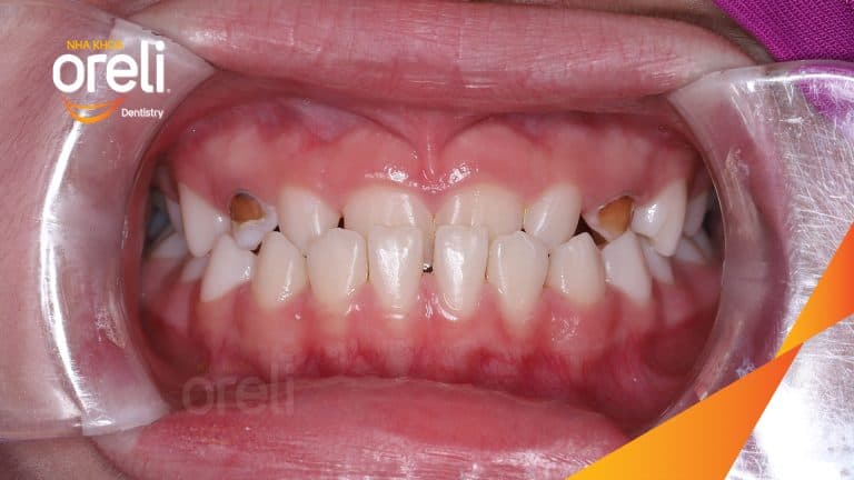 Ca niềng chỉnh cắn ngược trẻ em kết quả đúng khớp sau 12 tháng ở Oreli