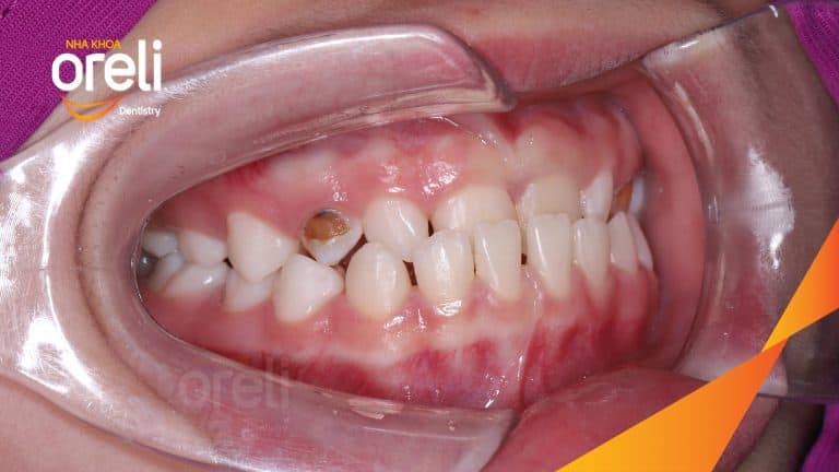 Ca niềng chỉnh cắn ngược trẻ em kết quả đúng khớp sau 12 tháng ở Oreli