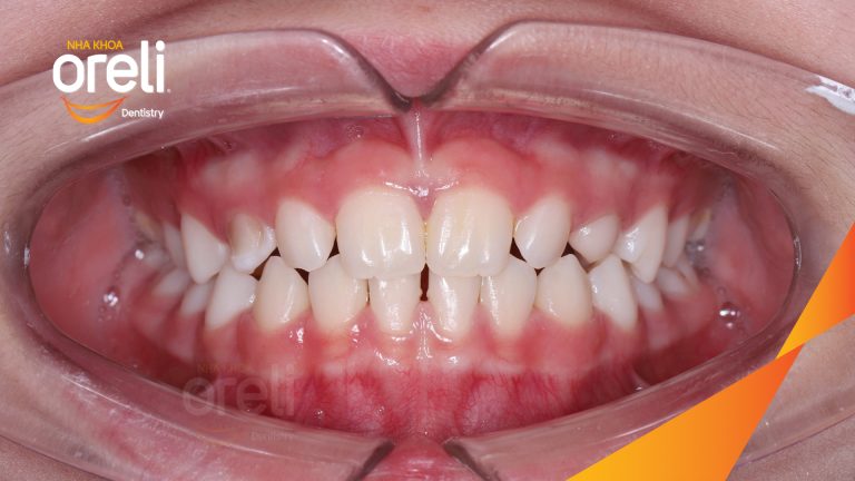 Ca niềng chỉnh cắn ngược trẻ em kết quả đúng khớp sau 12 tháng ở Oreli