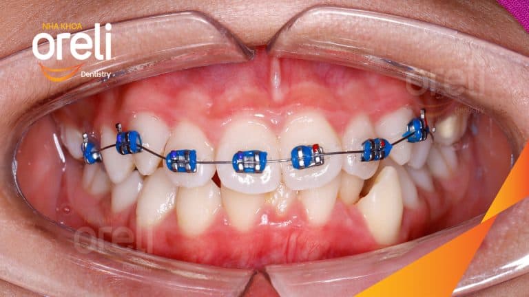 Ca chỉnh cắn sâu chen chúc hai hàm nặng