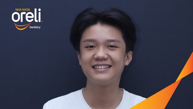 Ca chỉnh cắn sâu chen chúc hai hàm nặng