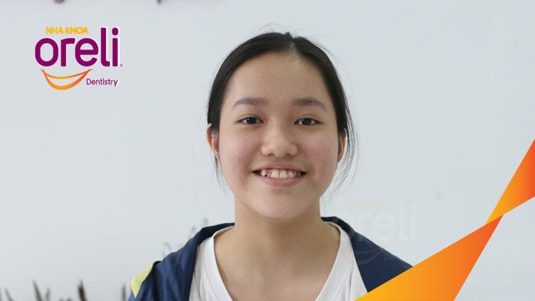 Niềng răng móm không phẫu thuật – Trước & sau tại Nha khoa Oreli