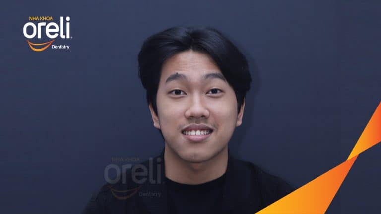 Niềng chỉnh lệch cằm sang phải