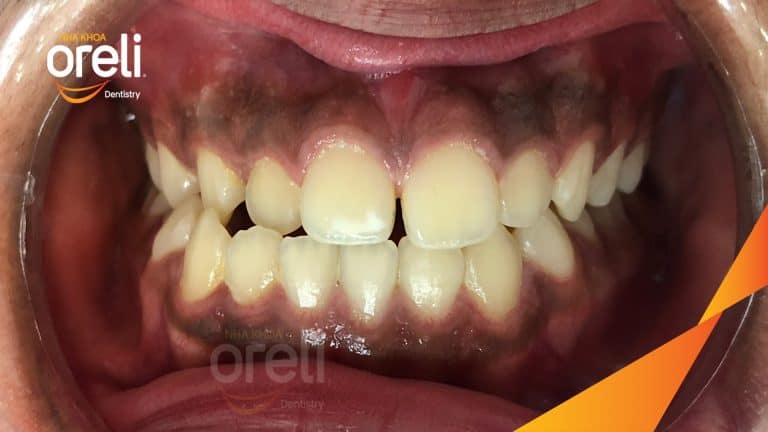 Niềng chỉnh lệch cằm sang phải