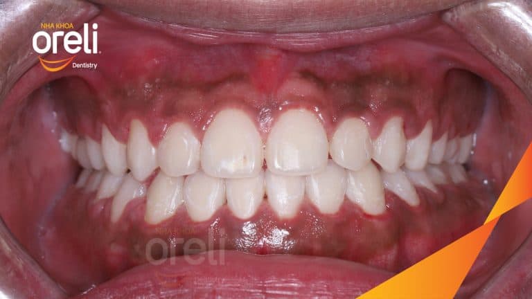 Niềng chỉnh lệch cằm sang phải