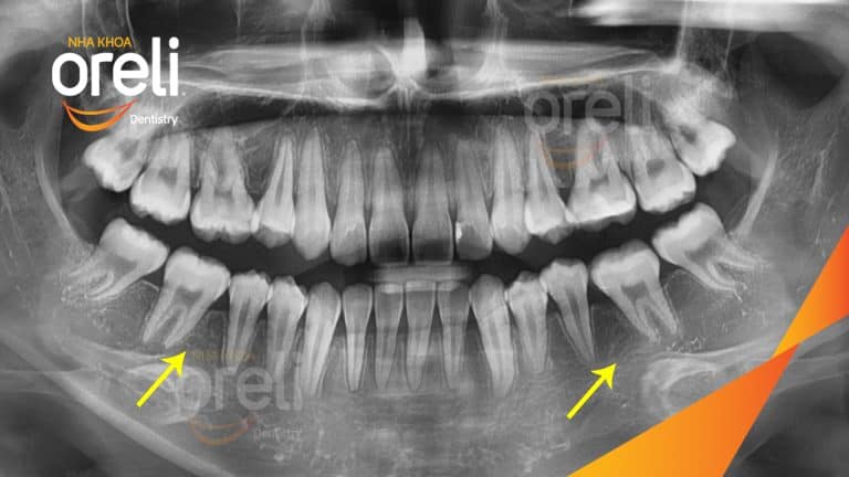 Ca niềng chỉnh hô nhổ 2 răng 4 hàm trên di gần răng 7 8 hàm dưới cho nụ cười đẹp – Kết quả sau hơn 2 năm ở Oreli