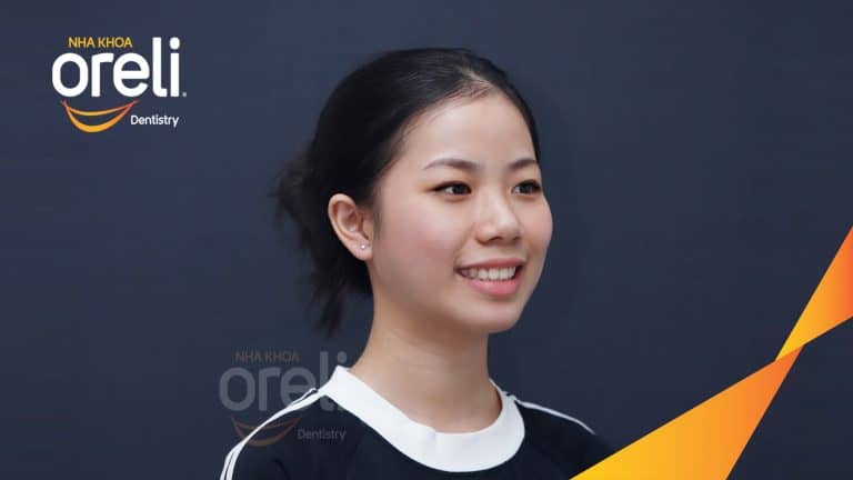 Ca niềng chỉnh hô nhổ 2 răng 4 hàm trên di gần răng 7 8 hàm dưới cho nụ cười đẹp – Kết quả sau hơn 2 năm ở Oreli
