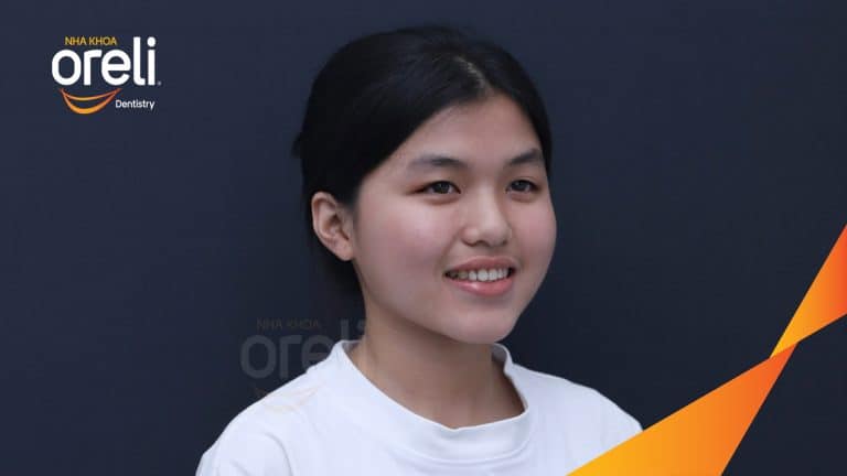 Ca niềng chỉnh cắn ngược răng cửa cho nụ cười đẹp tại Oreli