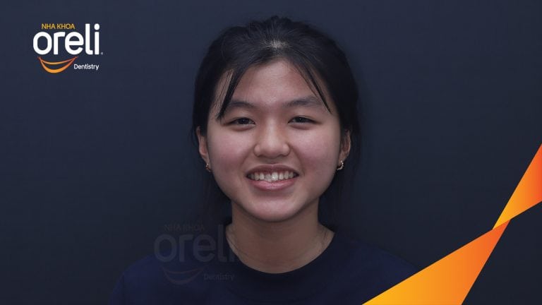 Ca niềng chỉnh cắn ngược răng cửa cho nụ cười đẹp tại Oreli