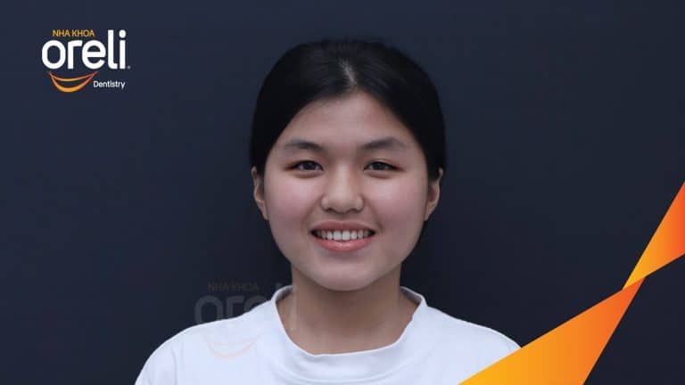 Ca niềng chỉnh cắn ngược răng cửa cho nụ cười đẹp tại Oreli