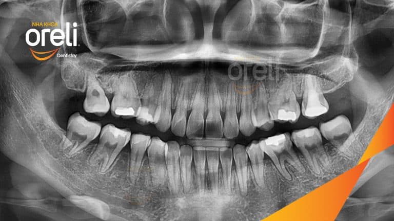 Niềng chỉnh hô và di gần răng 7 8 thay thế răng 6 kết quả thực tế tại Oreli