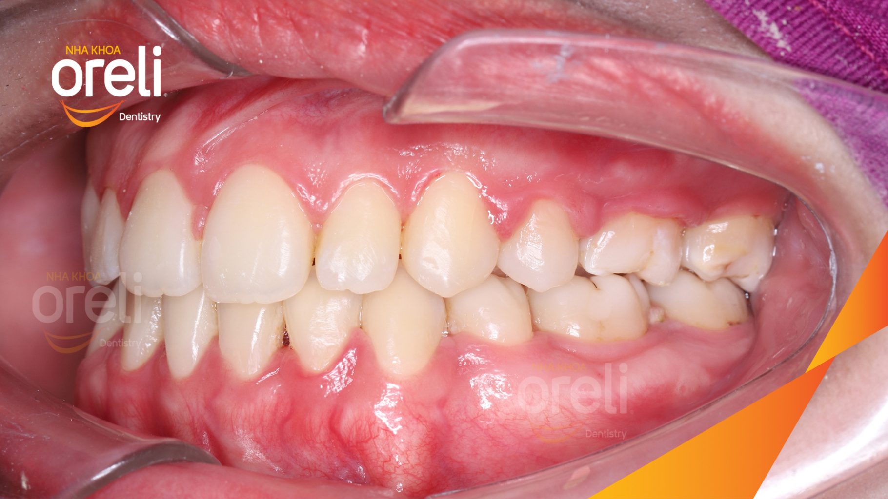 Kết quả đạt được sau 36 tháng - Khớp cắn đúng về hạng 1 nụ cười hài hòa mặt nghiêng đẹp tại Nha khoa Oreli Dentistry