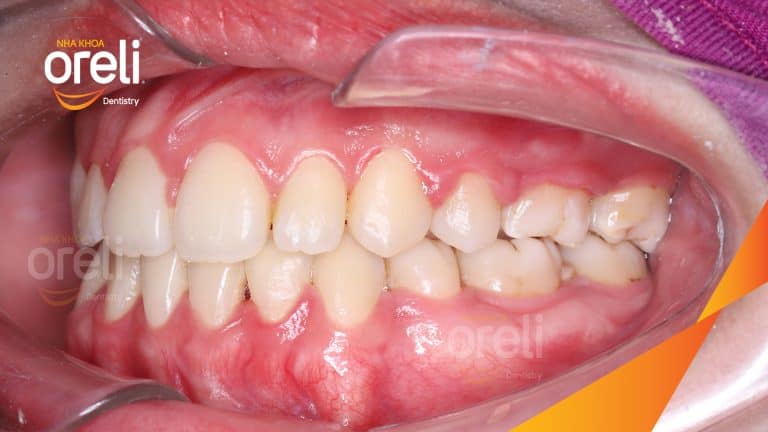 Niềng răng lệch khớp cắn tại Buôn Ma Thuột – Hành trình thay đổi nụ cười tại Nha khoa Oreli