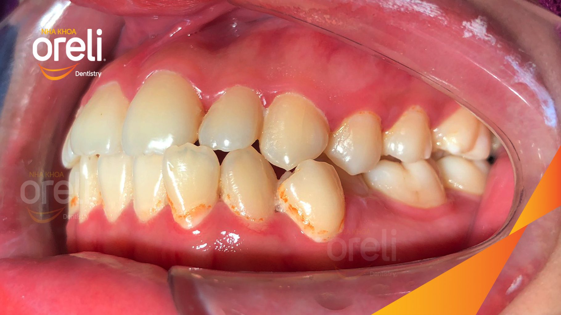 Kết quả sau 36 tháng: Khớp cắn đúng về hạng 1 nụ cười hài hòa mặt nghiêng đẹp tại Nha khoa Oreli Dentistry