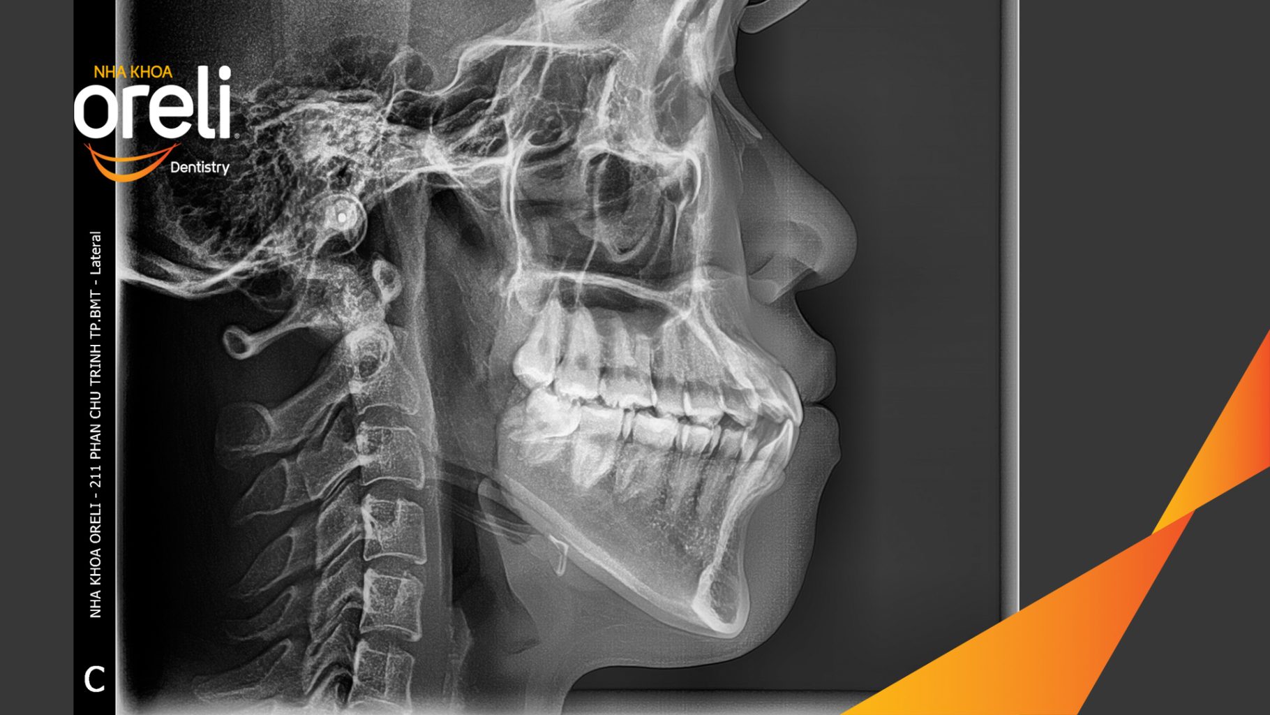 Trước điều trị: Sai khớp cắn hạng 3 kết hợp nhô xương ổ hai hàm tại Nha khoa Oreli Dentistry
