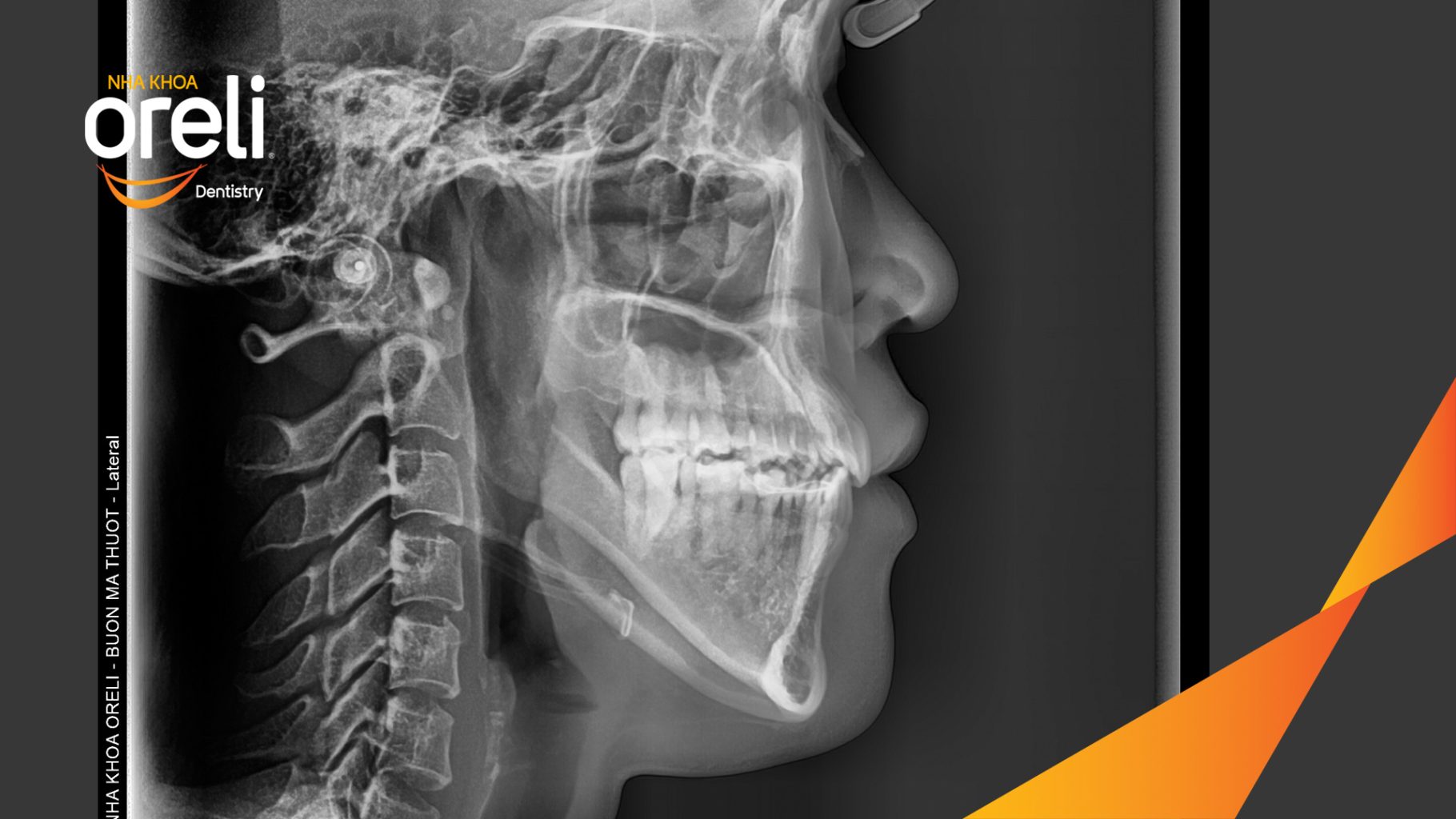 Sai khớp cắn hạng 3 kết hợp nhô xương ổ hai hàm trước khi điều trị tại Nha khoa Oreli Dentistry