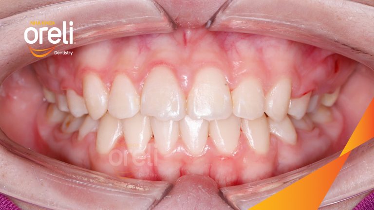 Ca niềng chỉnh hô có nhổ 4 răng 4 cho kết quả đẹp tại Oreli
