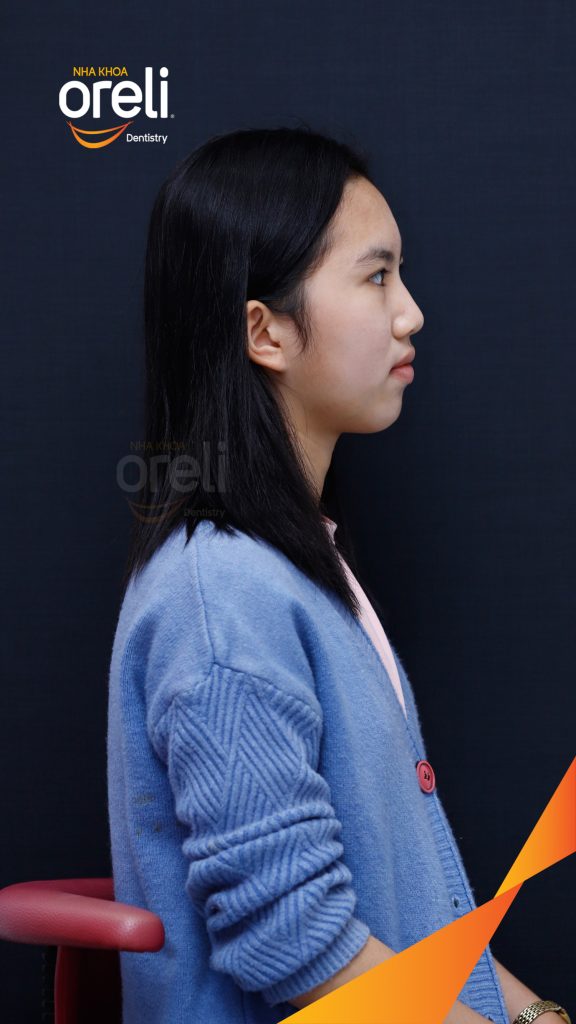 Trước điều trị:  tại Oreli