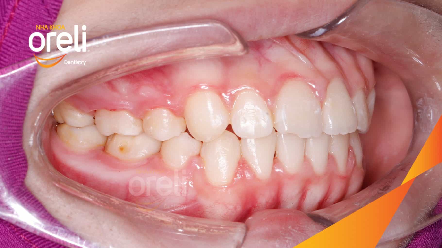 Ca niềng chỉnh hô có nhổ 4 răng 4 cho kết quả đẹp tại Oreli