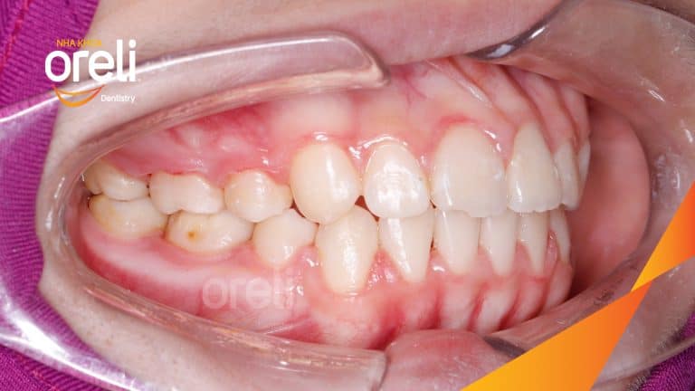 Ca niềng chỉnh hô có nhổ 4 răng 4 cho kết quả đẹp tại Oreli