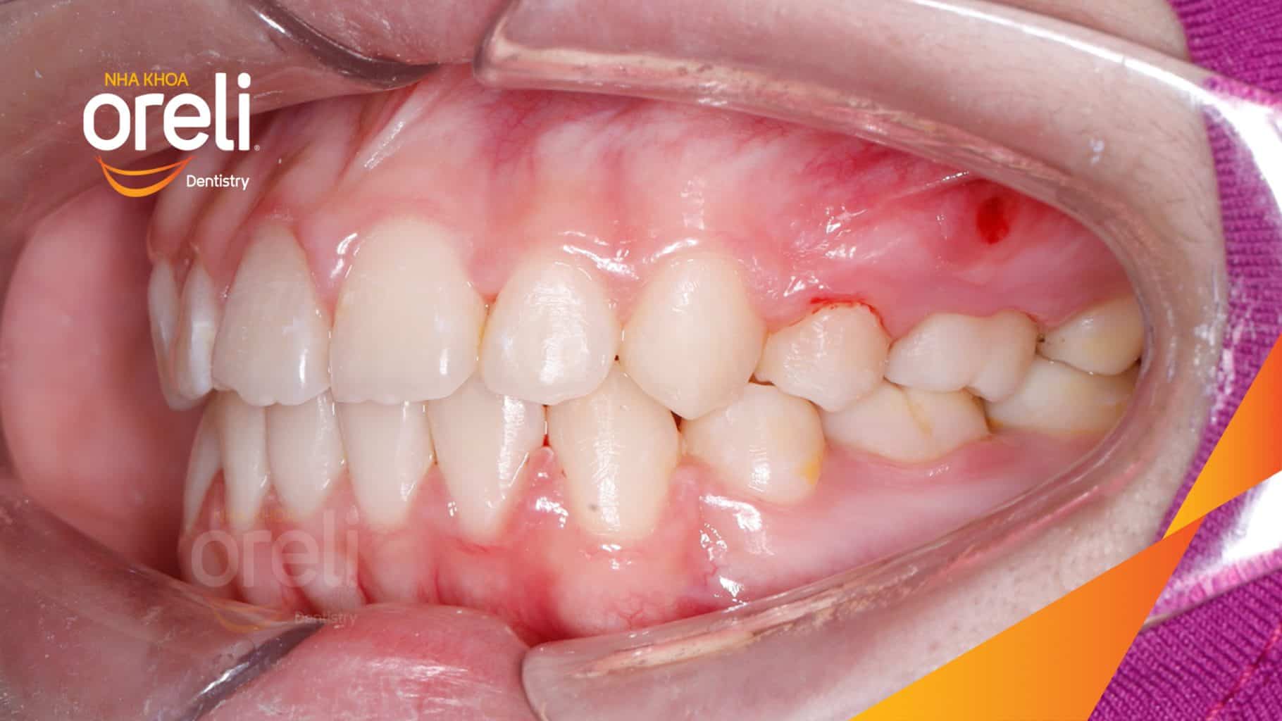 Ca niềng chỉnh hô có nhổ 4 răng 4 cho kết quả đẹp tại Oreli