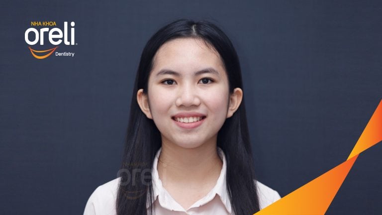 Ca niềng chỉnh hô có nhổ 4 răng 4 cho kết quả đẹp tại Oreli