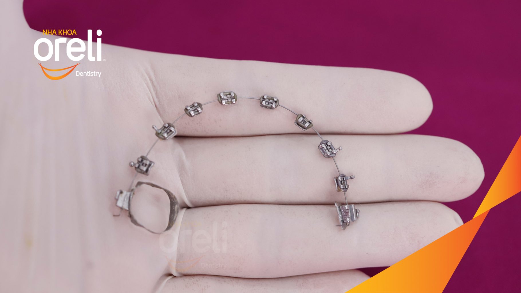 Trước điều trị:  tại Oreli