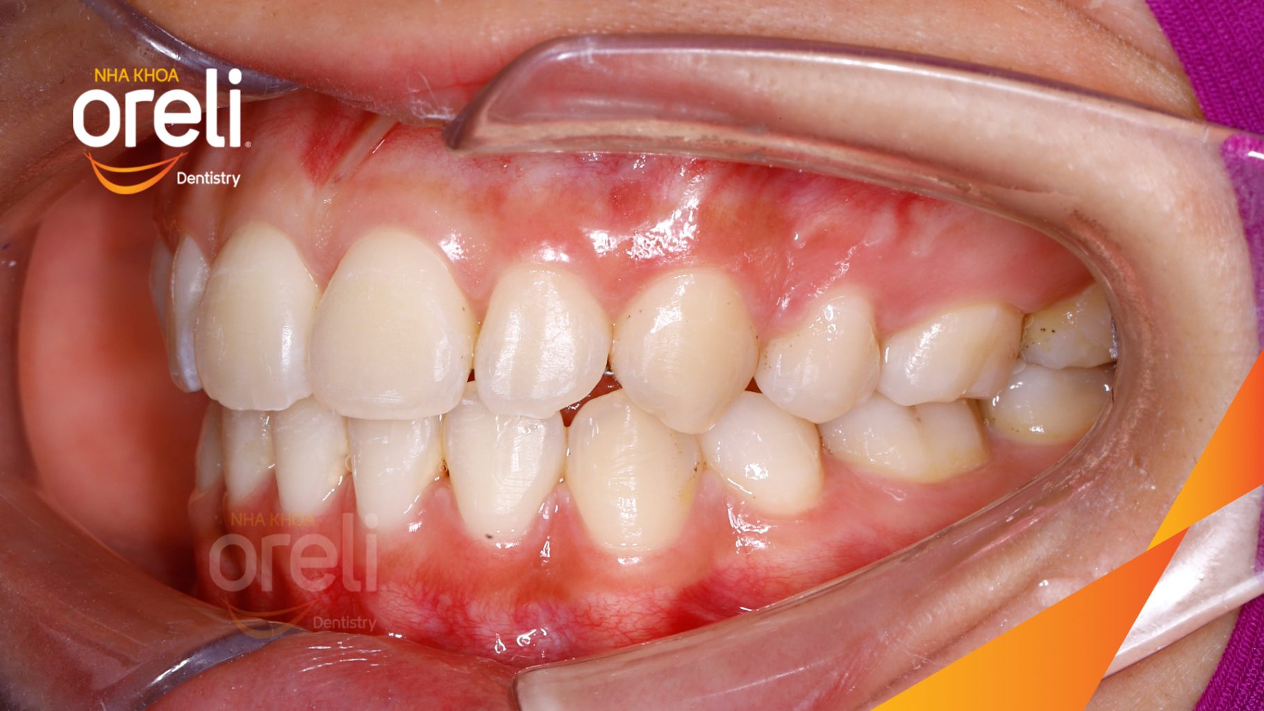 Kết quả đạt được sau 28 tháng - Khớp cắn đúng nụ cười tự nhiên, góc mặt nghiêng đẹp tại Nha khoa Oreli