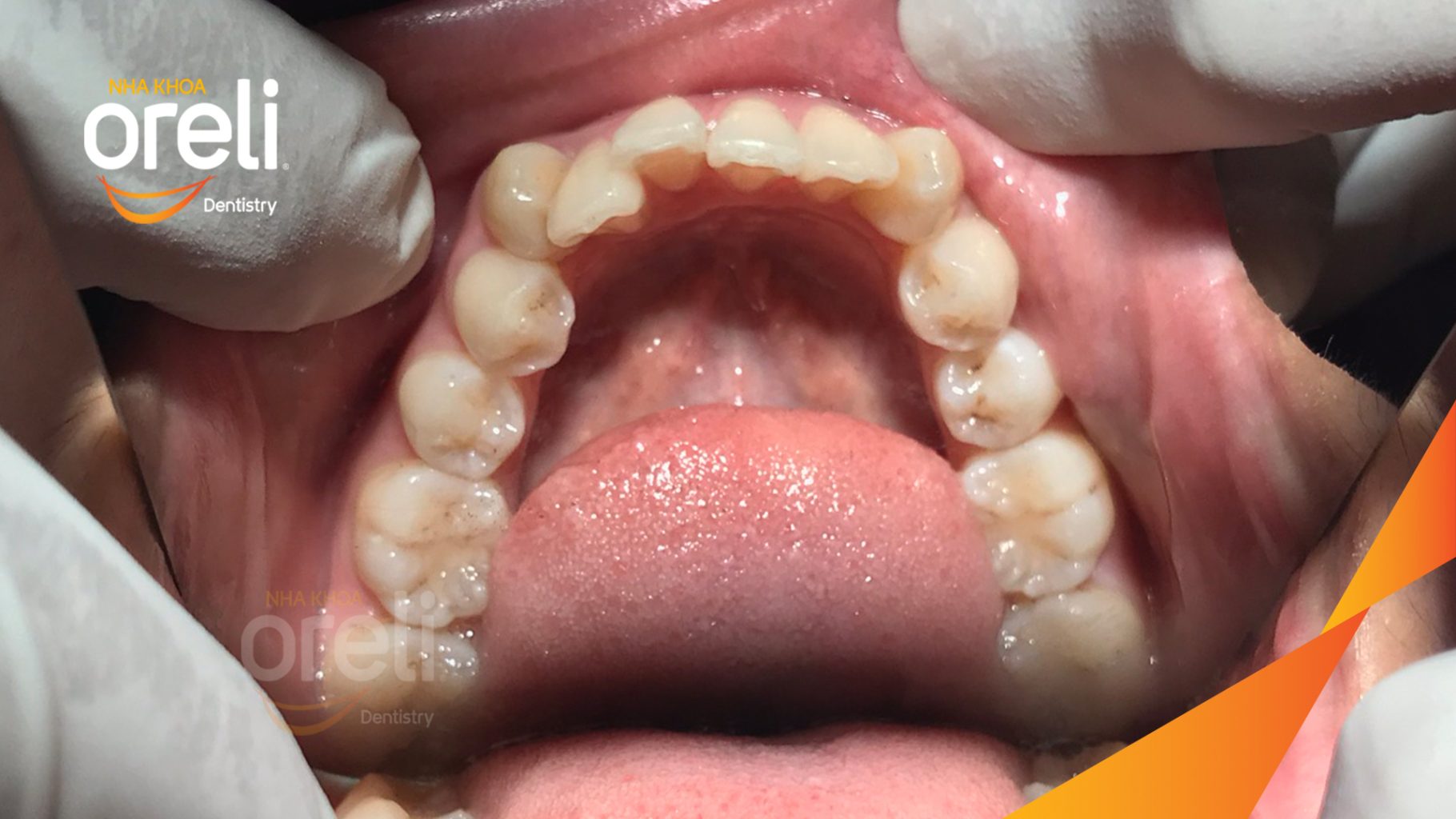 Kết quả sau 28 tháng: Khớp cắn đúng nụ cười tự nhiên, góc mặt nghiêng đẹp tại Nha khoa Oreli