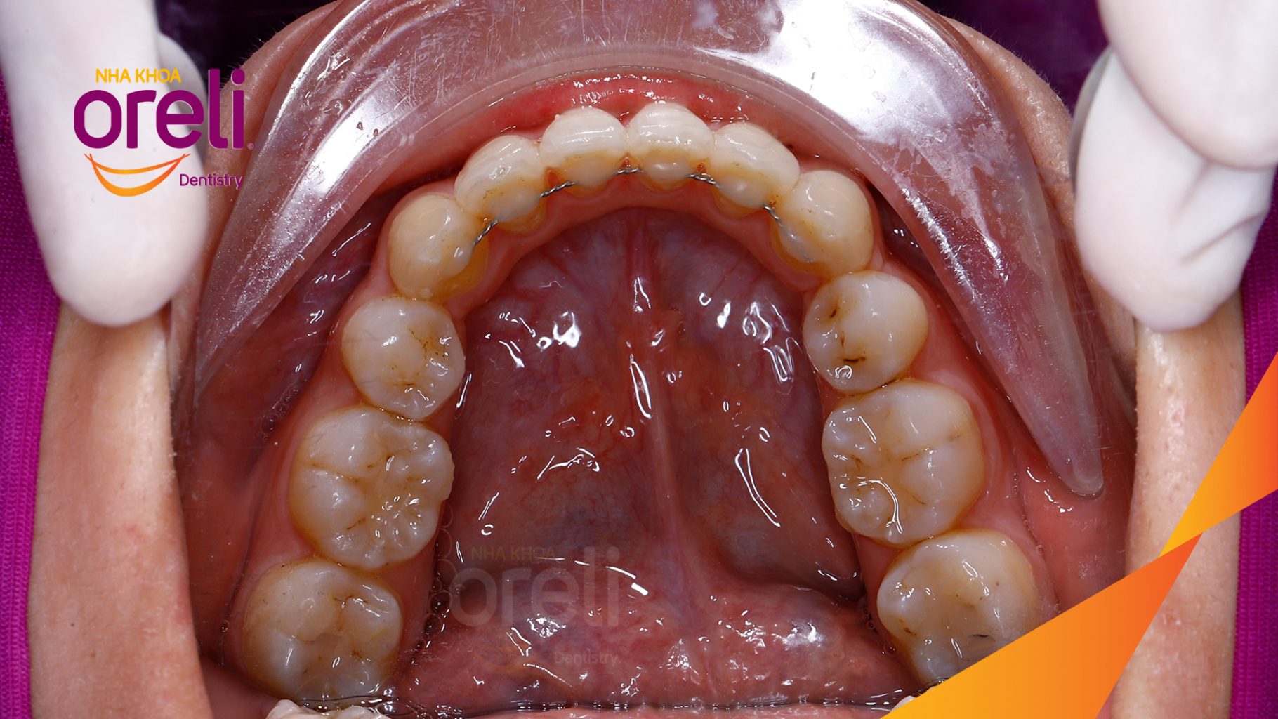 Kết quả đạt được sau 28 tháng - Khớp cắn đúng nụ cười tự nhiên, góc mặt nghiêng đẹp tại Nha khoa Oreli