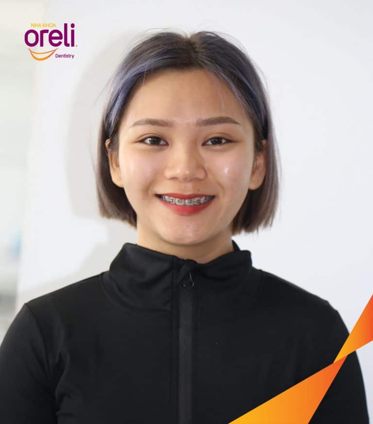 Niềng răng hô nặng phải nhổ 4 răng số 4 cho góc nghiêng và hàm răng đều đẹp – Hành trình tại Oreli