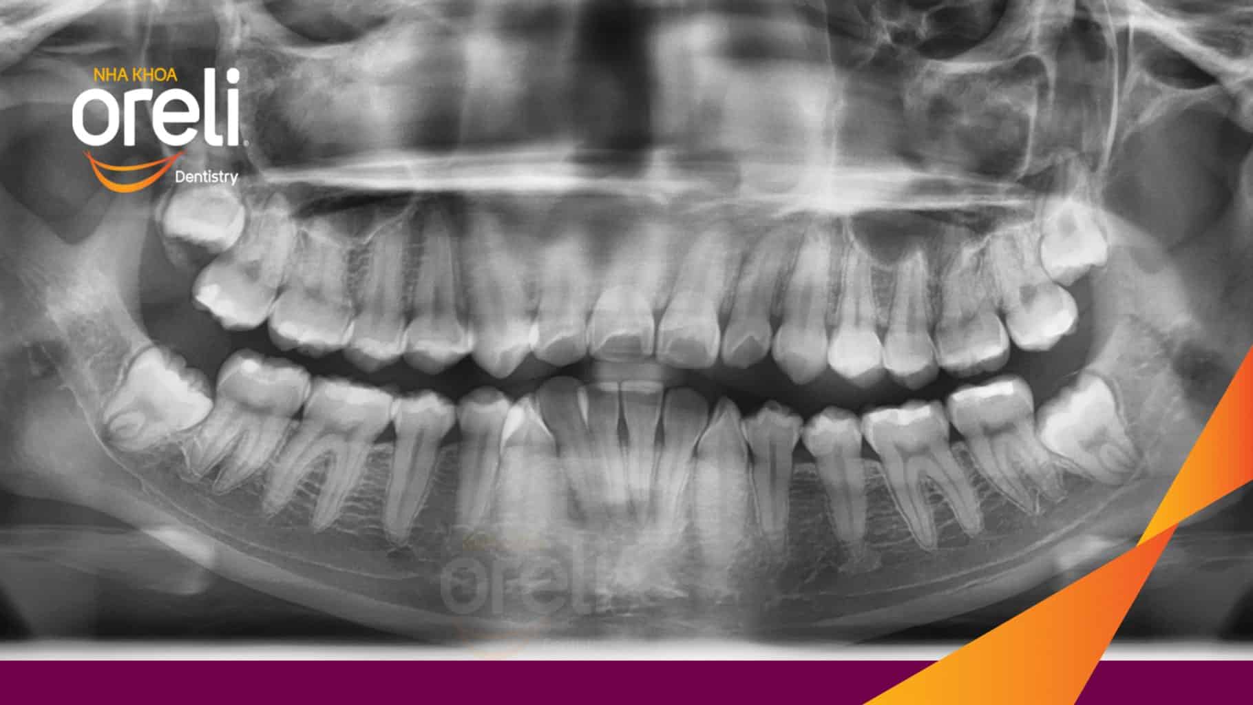 Niềng răng hô nặng phải nhổ 4 răng số 4 cho góc nghiêng và hàm răng đều đẹp – Hành trình tại Oreli