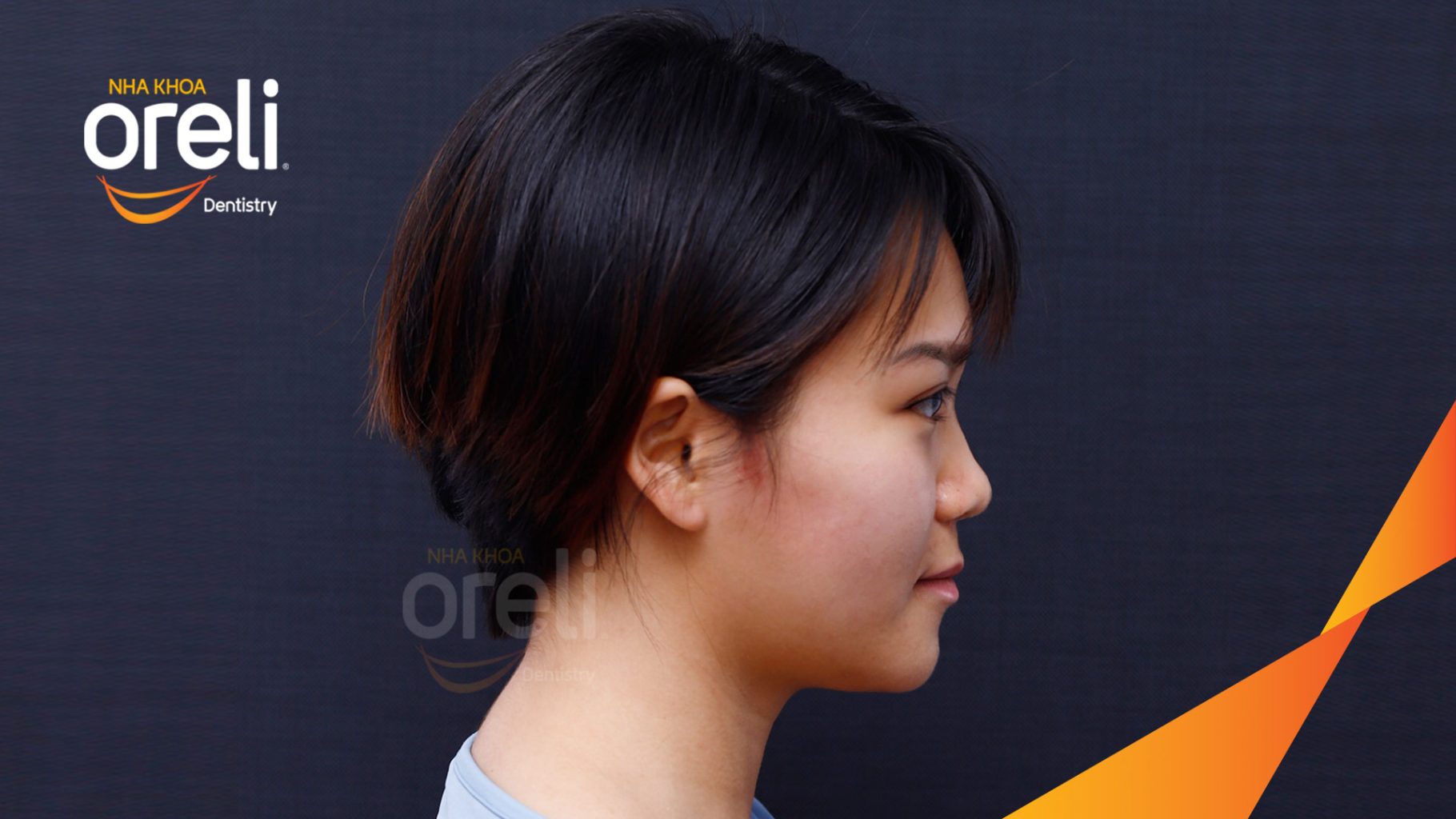 Thực hiện Nhổ 4 răng số 4 niềng răng với măc cài kim loại kéo dài 28 tháng tại Nha khoa Oreli