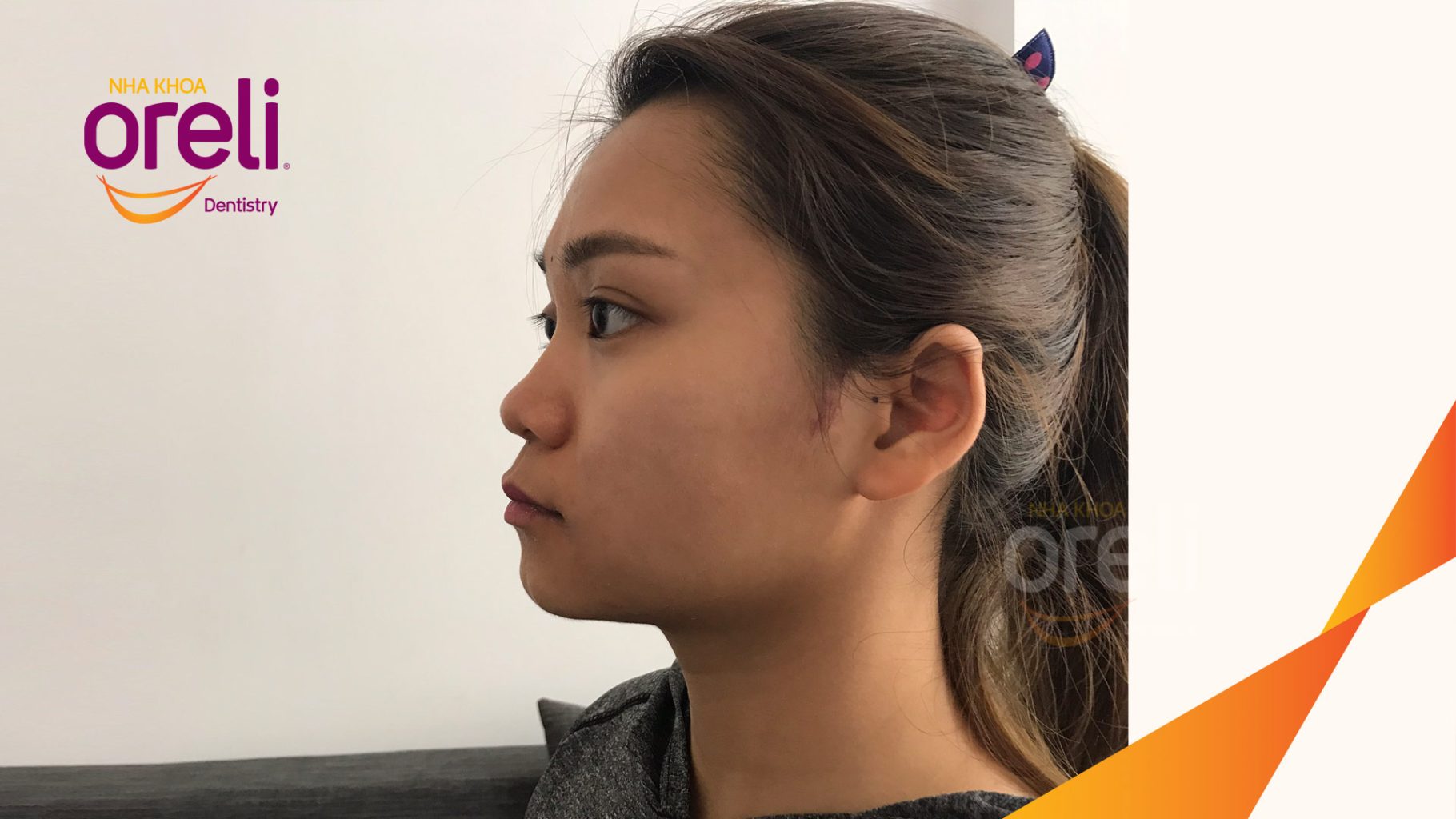 Trước điều trị: Răng hô nhô xương ổ hai hàm tại Nha khoa Oreli