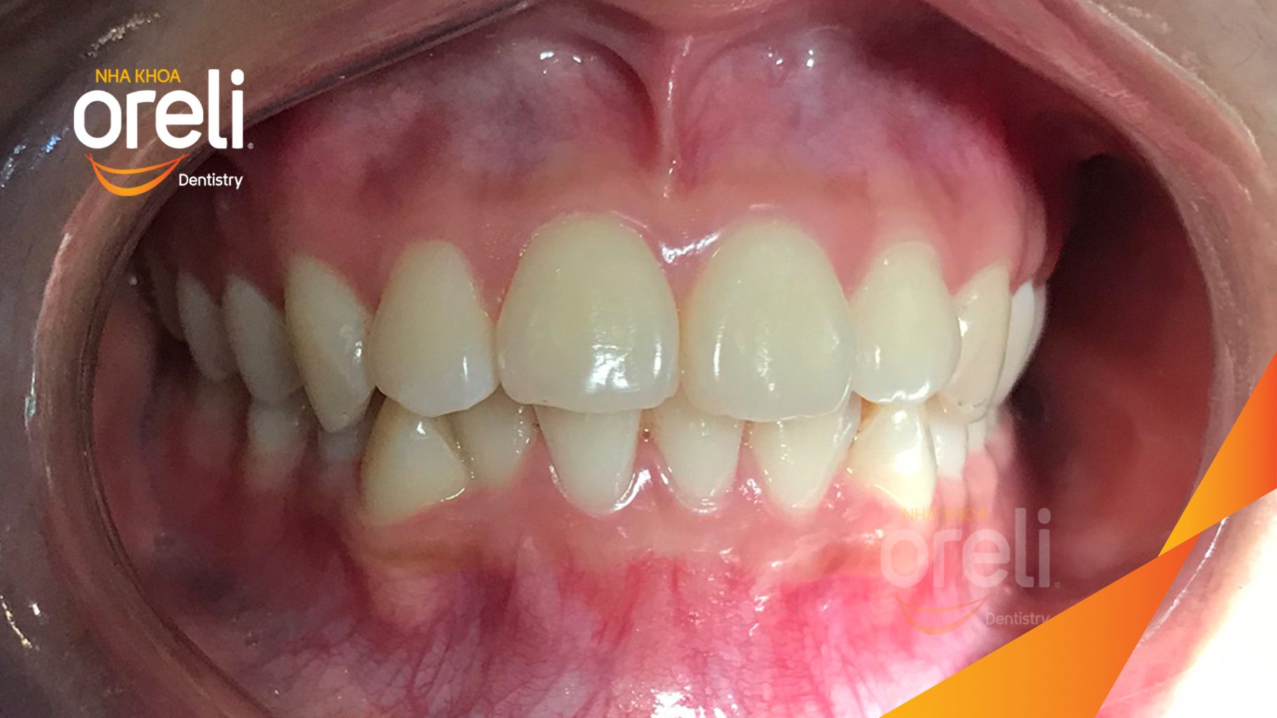 Trước điều trị: Răng hô nhô xương ổ hai hàm tại Nha khoa Oreli