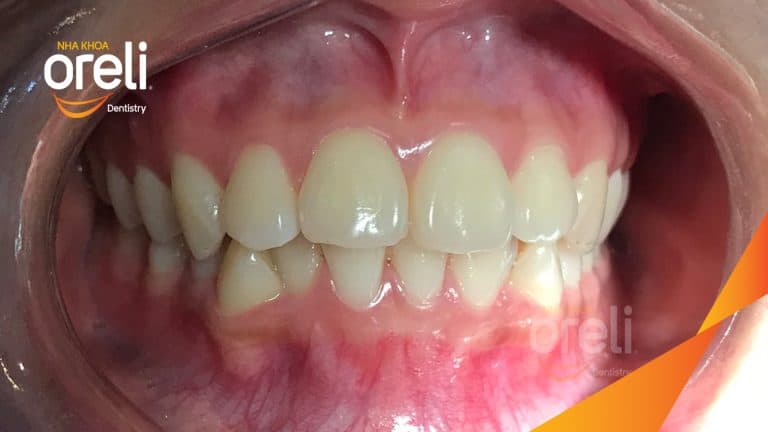 Niềng răng hô nặng phải nhổ 4 răng số 4 cho góc nghiêng và hàm răng đều đẹp – Hành trình tại Oreli