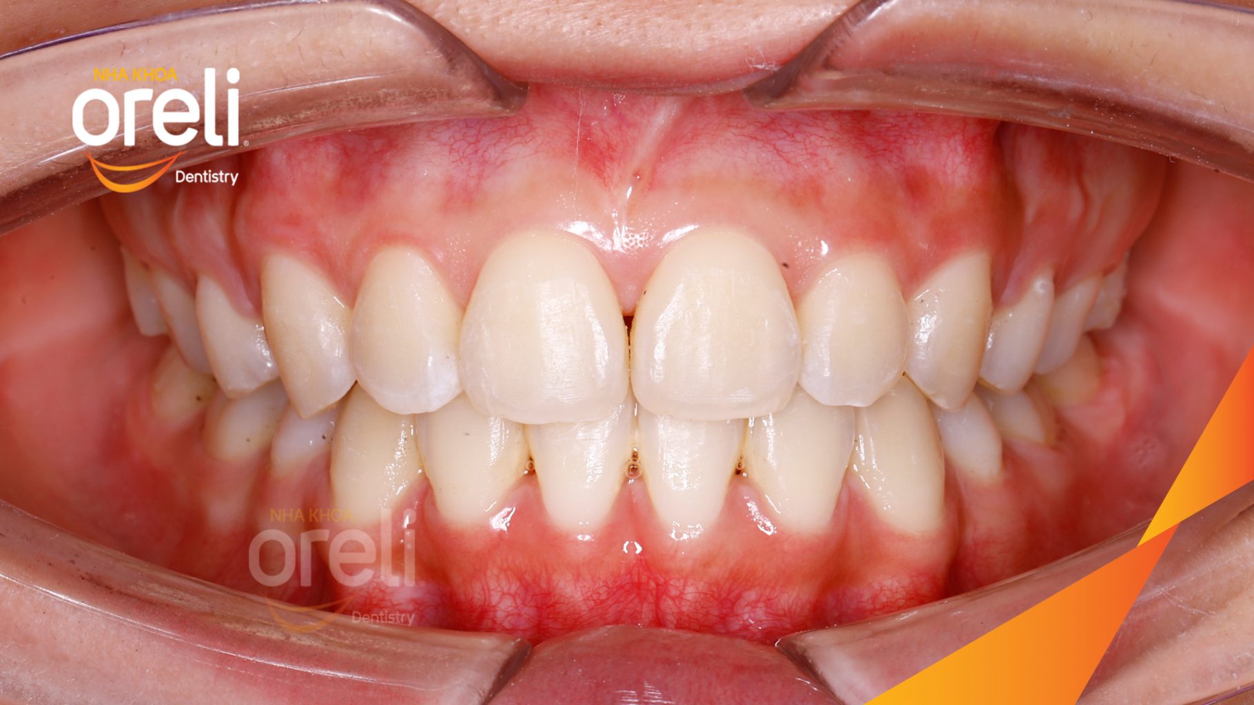 Răng hô nhô xương ổ hai hàm trước khi điều trị tại Nha khoa Oreli