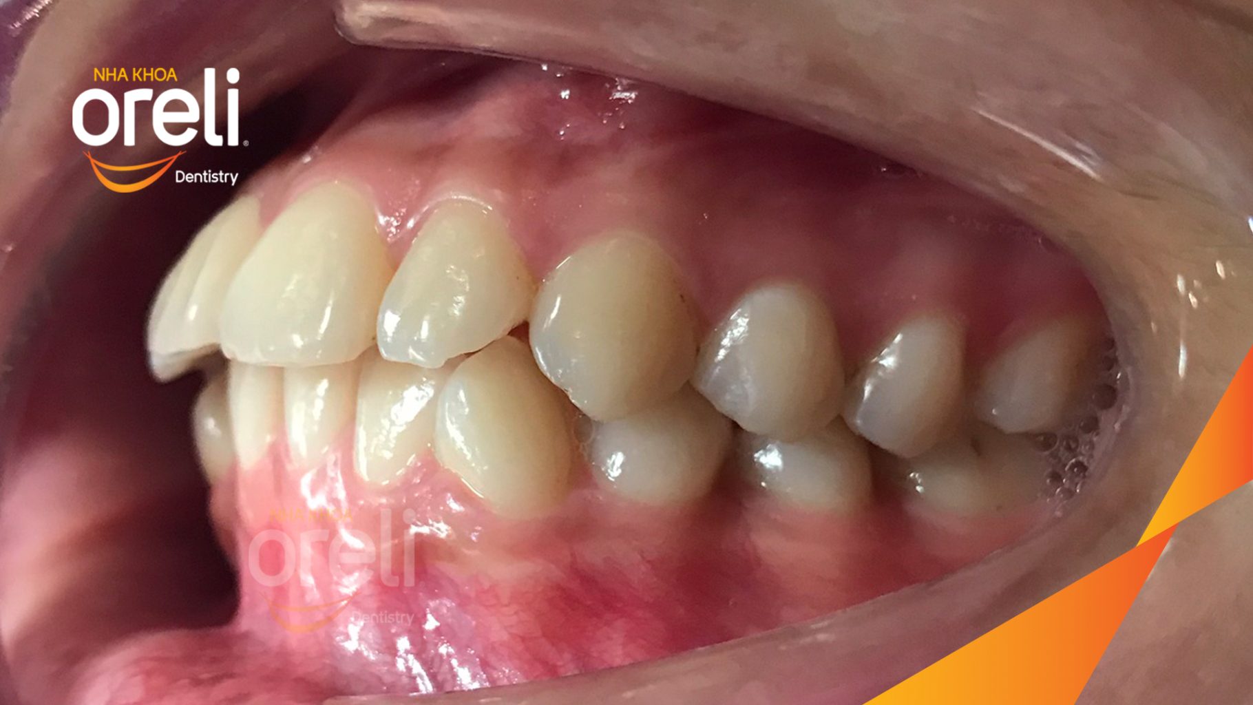 Kết quả sau 28 tháng: Khớp cắn đúng nụ cười tự nhiên, góc mặt nghiêng đẹp tại Nha khoa Oreli