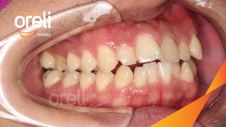Ca niềng chỉnh hô lẹm cằm có nhổ 4 răng 4 tại Oreli