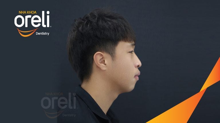 Ca niềng chỉnh hô lẹm cằm có nhổ 4 răng 4 tại Oreli