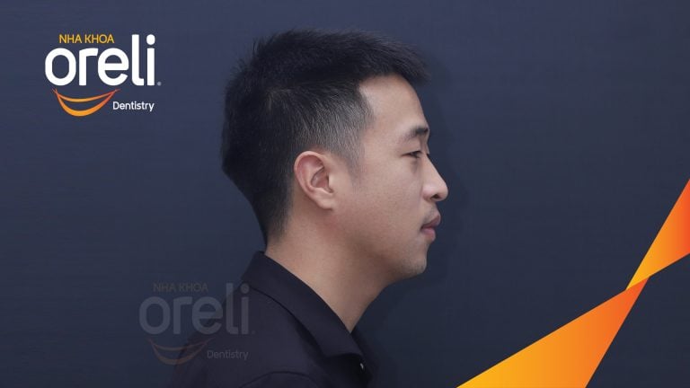 Ca niềng chỉnh hô lẹm cằm có nhổ 4 răng 4 tại Oreli