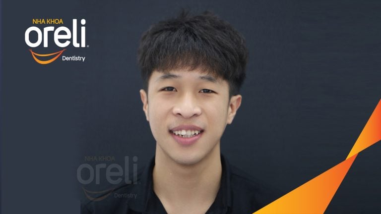 Ca niềng chỉnh hô lẹm cằm có nhổ 4 răng 4 tại Oreli