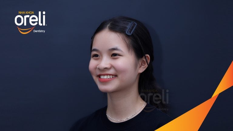 Ca niềng chỉnh cắn ngược hàm trên kết quả sau 18 tháng tại Oreli