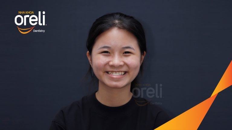 Ca niềng chỉnh cắn ngược hàm trên kết quả sau 18 tháng tại Oreli