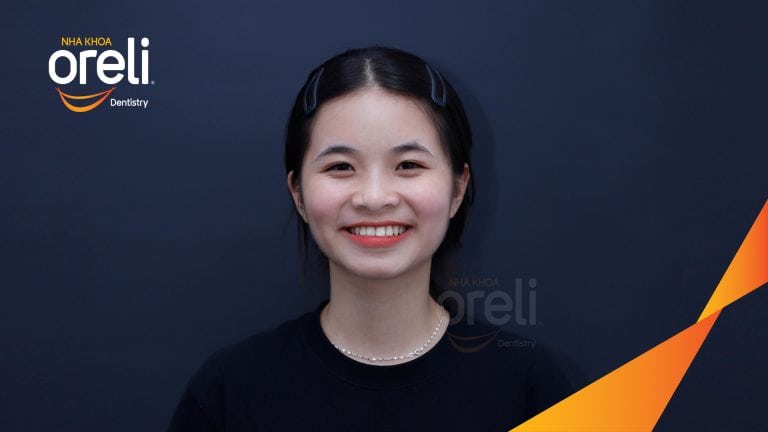 Ca niềng chỉnh cắn ngược hàm trên kết quả sau 18 tháng tại Oreli