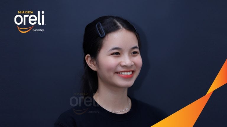 Ca niềng chỉnh cắn ngược hàm trên kết quả sau 18 tháng tại Oreli