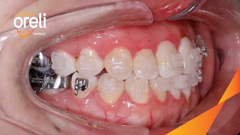 Chỉnh hạng 3 móm nặng di xa toàn hàm không nhổ răng – Kết quả thực tế tại Oreli