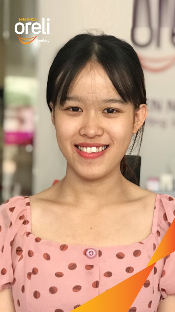 Trước điều trị:  tại Oreli