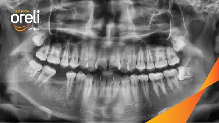 Ca niềng răng sai khớp cắn hạng 3 móm chen chúc kèm di gần răng số 7 8 thay thế răng 6 ở Oreli